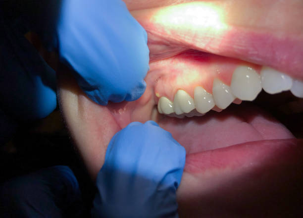 Best Broken Tooth Emergency  in Palm River Clair Mel, FL